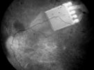 Implant podsiatkówkowy widoczny w badaniu dna oka (fot. Retina Implant GmbH)