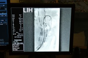 W Uniwersyteckim Szpitalu Klinicznym w Białymstoku przeprowadzono 9 października pierwszą na Podlasiu wewnątrznaczyniową operację tętniaka aorty obejmującego tętnice trzewne