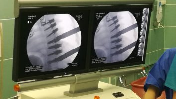 Pediatric scoliosis surgery without stiffening the spine performed in the University Children’s Clinical Hospital for the first time in Poland
