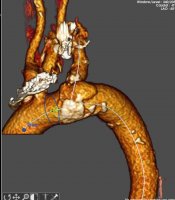 Surgeons from the Department of Vascular Surgery and Transplantation saved the life of a man with aortic dissection