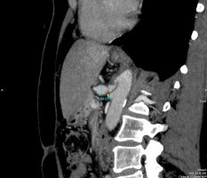 Nowatorska operacja uwolnienia więzadła łukowatego pośrodkowego metodą laparoskopową UMB