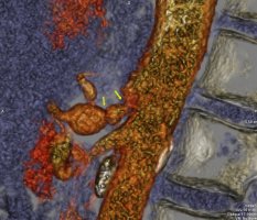 Nowatorska operacja uwolnienia więzadła łukowatego pośrodkowego metodą laparoskopową UMB Nowatorska operacja uwolnienia więzadła łukowatego pośrodkowego metodą laparoskopową UMB