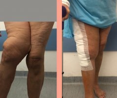 Lekarze z Kliniki Ortopedii, Traumatologii i Chirurgii Ręki USK przeprowadzili operację wymiany dwóch stawów i całej kości udowej