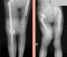 Lekarze z Kliniki Ortopedii, Traumatologii i Chirurgii Ręki USK przeprowadzili operację wymiany dwóch stawów i całej kości udowej