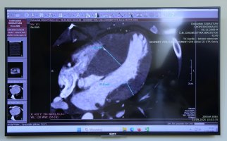 Operacja w USK szansą na uniknięcie przeszczepu serca Operacja w USK szansą na uniknięcie przeszczepu serca