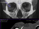 Obraz tomografii komputerowej pokazujący przewód zasilający implant wewnątrz oczodołu