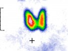 Obraz scyntygraficzny tej samej tarczycy po leczeniu I-131
