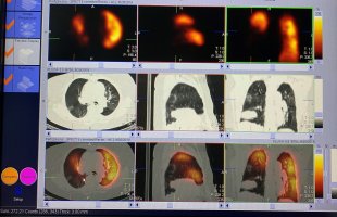 scyntygrafia SPECT/CT perfuzji płuc